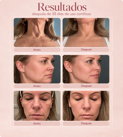 Tratamiento Lifting Facial y de Cuello con EMS y Luz Roja